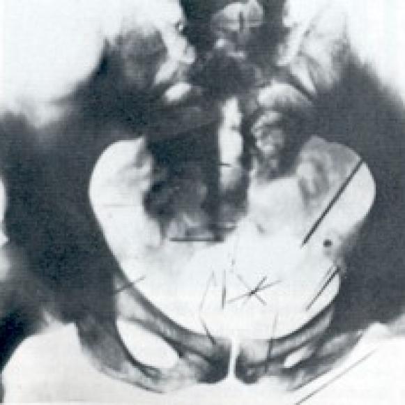 X-ray of Albert Fish’s pelvis, loaded with self-embedded needles